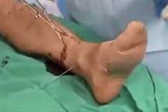 折れた足の骨をつなぐ手術の映像